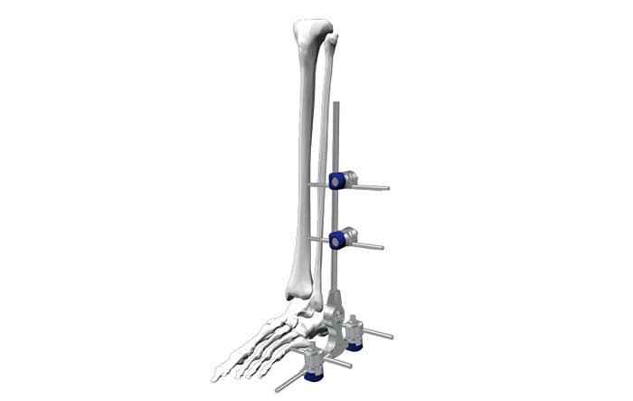 解剖IV型Φ8－踝关节固定