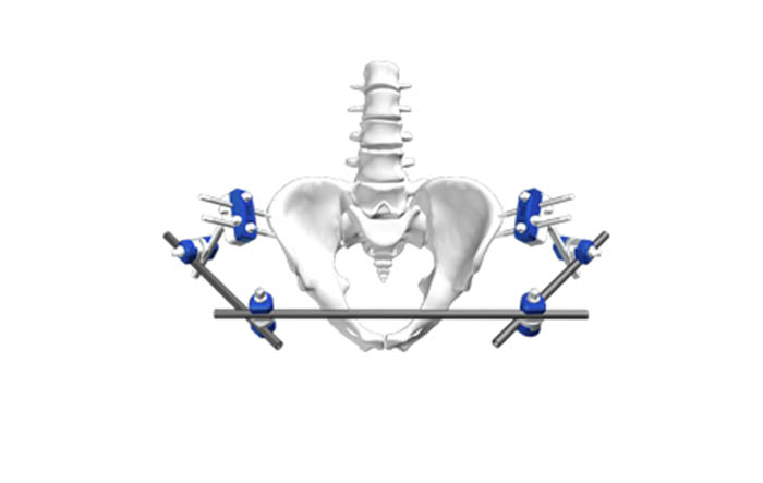 解剖IV型Φ8－骨盆固定