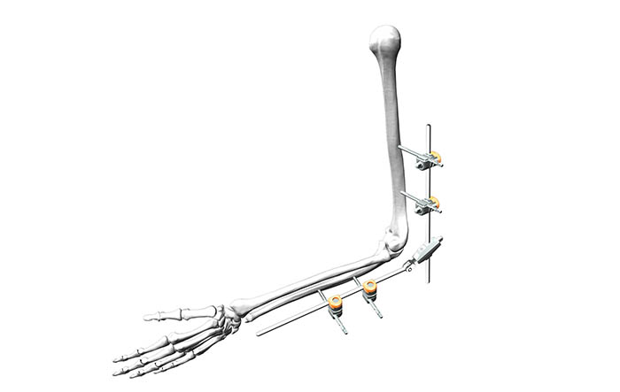 解剖IV型Φ5-儿童肘关节固定